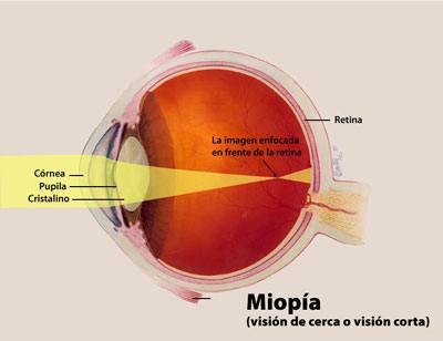 Salud Visual 2, la miopía