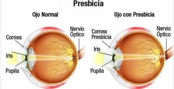 Salud visual 5, Presbicia.