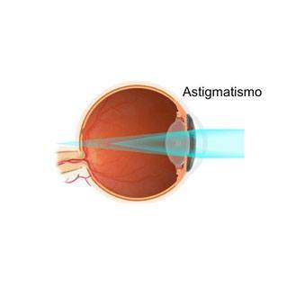 Salud Visual 4, El astigmatismo.