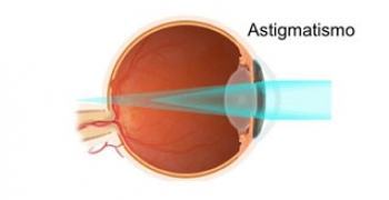 Salud Visual 4, El astigmatismo.