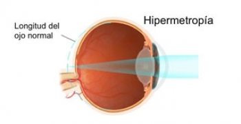 Salud Visual 3, La hipermetropía.