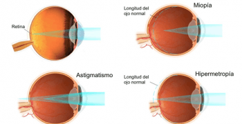 Salud Visual, defectos visuales mas comunes